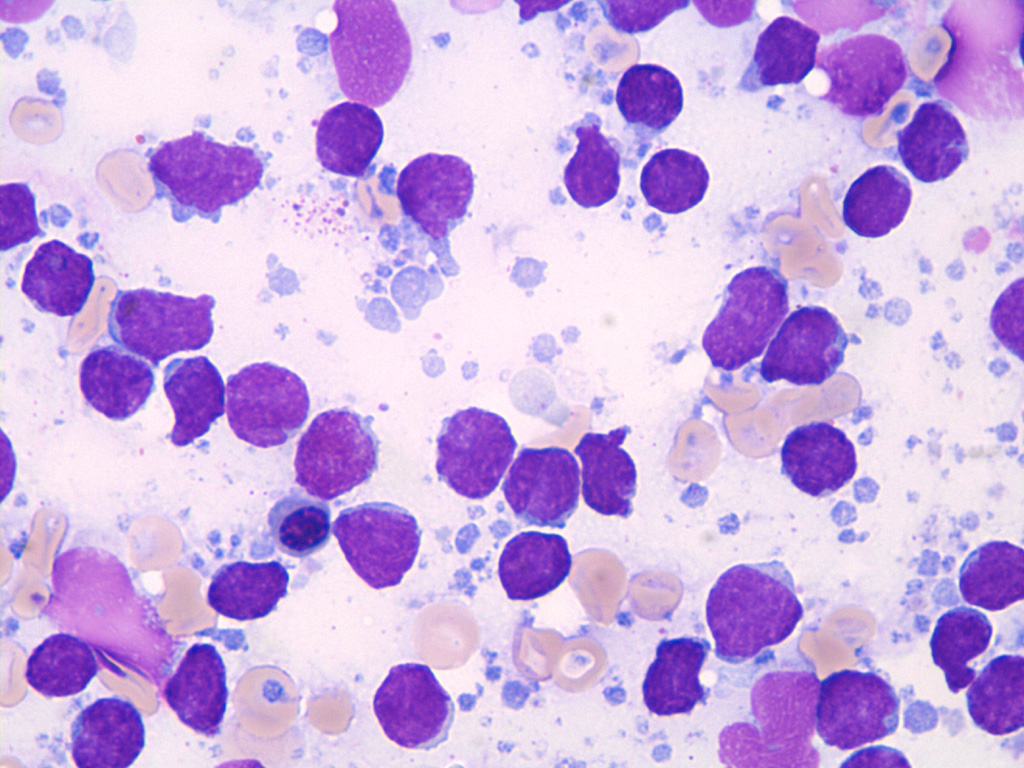 MantelzellLymphom Bildserie Knochenmarkzytologie