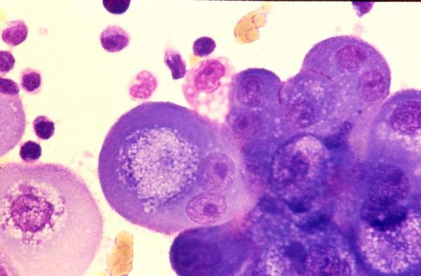 calretinin in mesothelioma