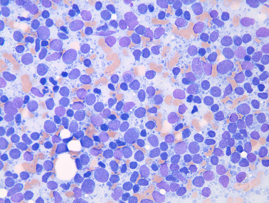 MantelzellLymphom Bildserie Lymphknotenzytologie Feinnadelaspirat